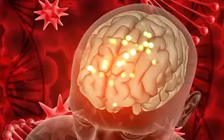 Illustrative image for Brain Haemorrhage patient information