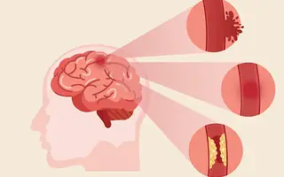 Illustrative image for Brain Tumour patient information