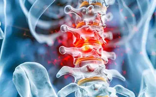 Illustrative image for Slip Disc & Sciatica patient information