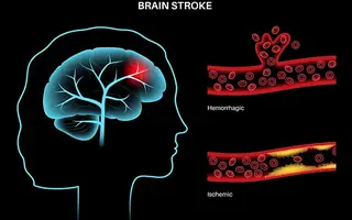Illustrative image for Stroke / Paralysis patient information