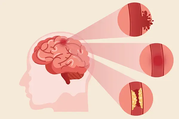 Illustration of abnormal growths in the brain accompanying brain tumour information