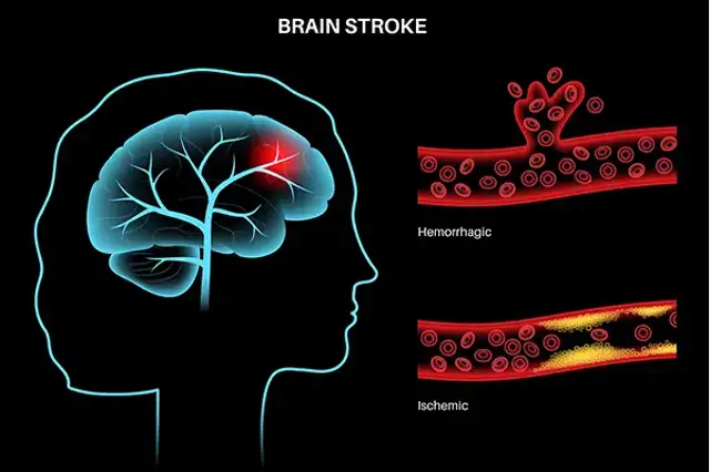 Diagram comparing a blocked blood vessel and bleeding in the brain