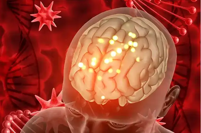 Illustration of bleeding affecting the brain